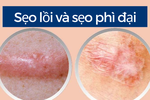 Bạn đang bị sẹo lồi hay sẹo phì đại?