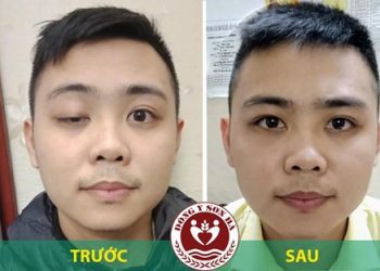 Tự nhiên sụp mí mắt phải làm sao?